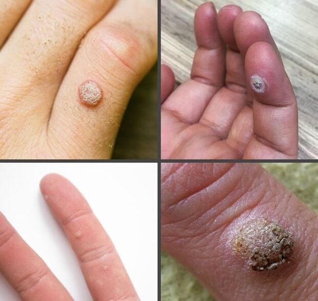 סוגים נפוצים של יבלות על האצבעות